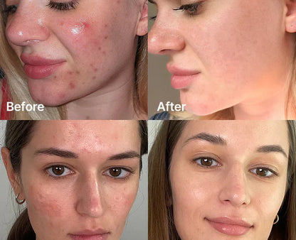 Medicube Red Succinic Acid Serum for Acne & Oil Control – Pore Minimizing Niacinamide Serum (UAE)