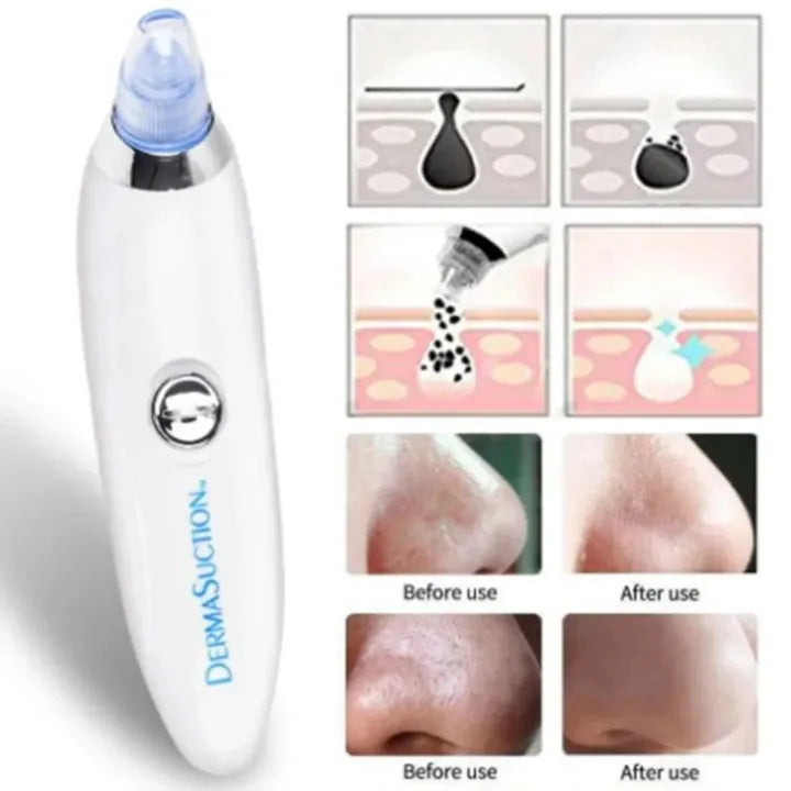 DermaSuction device with before and after use images on a white background