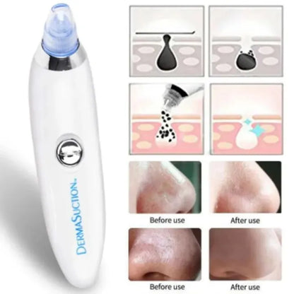 DermaSuction device with before and after use images on a white background